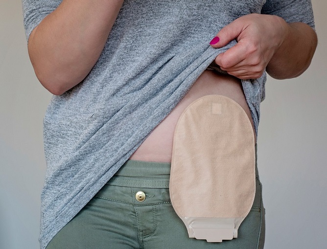 living-with-an-ostomy-and-managing-it-well